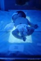 Bilirubin Phototherapy