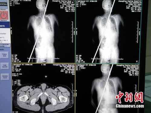 CT image of chinese man impaled with steel pole